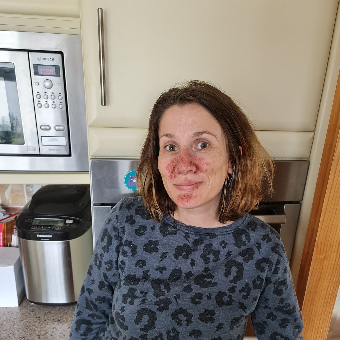 This first cycle on the new drugs might have felt like a baptism of fire and I might be dealing with this chemo rash on my face, but I'm one cycle down 🥳. This photo doesn't show just how red and sore my skin is really looking and feeling. I feel very self conscious. But in the grand scheme of things it's fine really. Just imagine all of the nasties the chemo is zapping on the inside! 
I'm very grateful for the fact we have a spin bike as I really don't feel like leaving the house at the moment. I jumped on the bike earlier and I cycled and sang (badly) along to Tina Turner and The Greatest Showman. I loved it and those endorphins were pumping by the time I'd finished.💃💃 
 I hope you all have a lovely weekend and that it's not raining where you are. It feels like Jersey has skipped straight to Autumn  xx
#bowelcancerawareness #bowelcanceruk #chemosideeffects